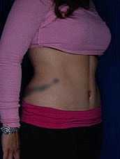 Tummy Tuck Before & After