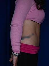 Tummy Tuck Before & After
