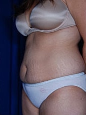 Tummy Tuck Before & After