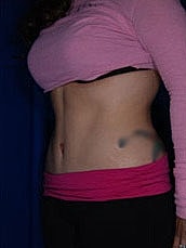 Tummy Tuck Before & After