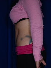 Tummy Tuck Before & After