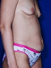 Tummy Tuck Before & After