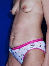 Tummy Tuck Before & After