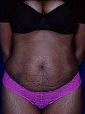 Tummy Tuck Before & After