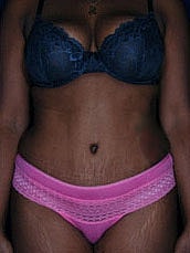 Tummy Tuck Before & After