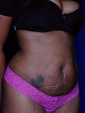 Tummy Tuck Before & After