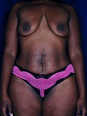 Tummy Tuck Before & After