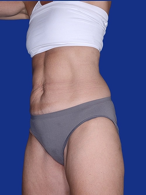 Tummy Tuck Before & After