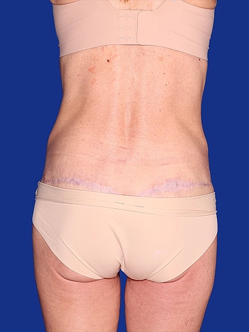 Tummy Tuck Before & After