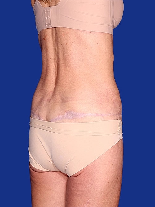 Tummy Tuck Before & After