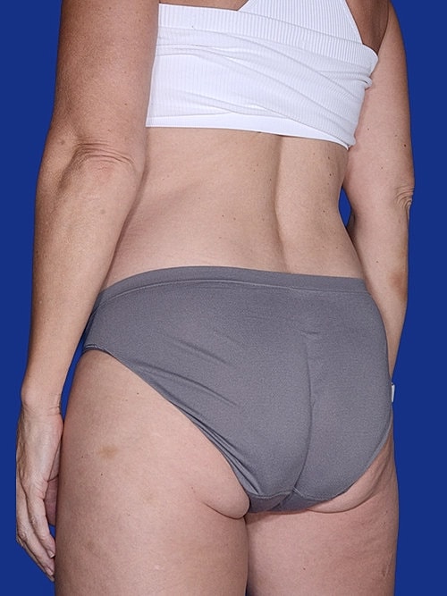 Tummy Tuck Before & After