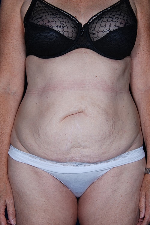 Tummy Tuck Before & After