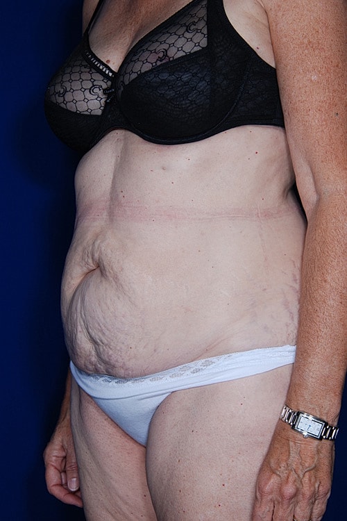 Tummy Tuck Before & After