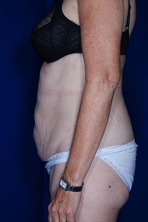 Tummy Tuck Before & After