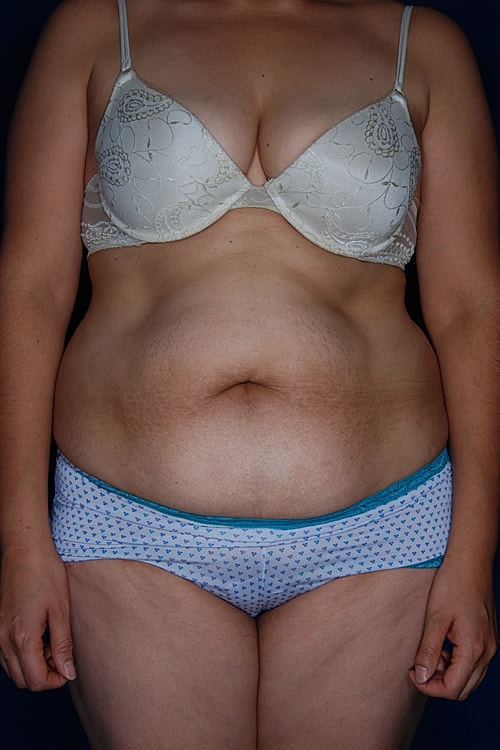 Tummy Tuck Before & After
