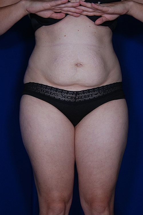 Tummy Tuck Before & After