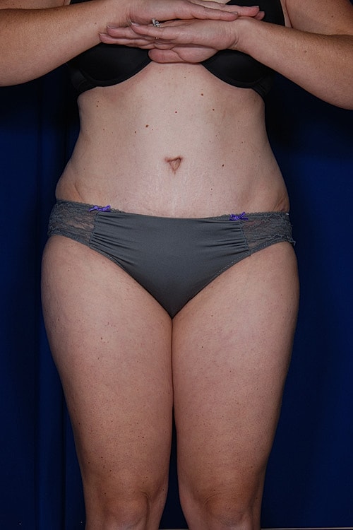 Tummy Tuck Before & After
