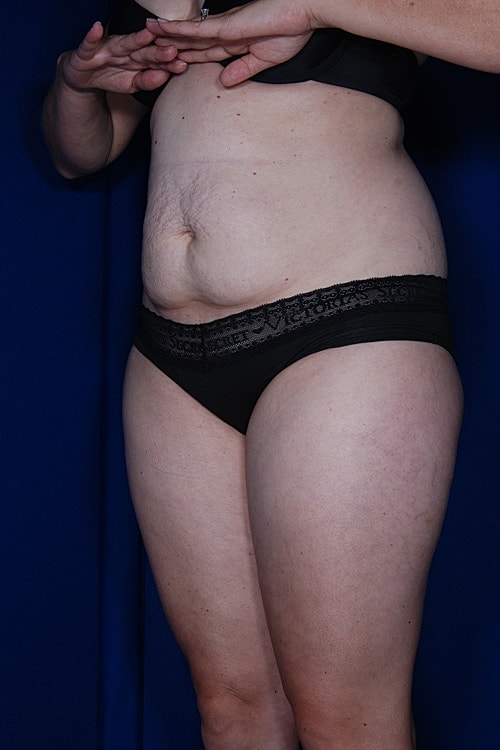 Tummy Tuck Before & After