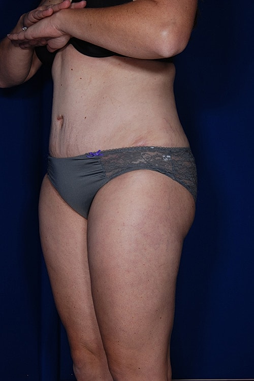 Tummy Tuck Before & After