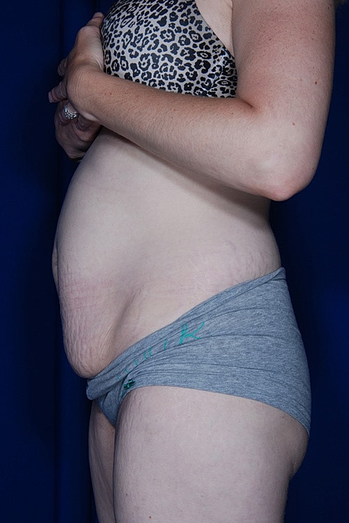 Tummy Tuck Before & After