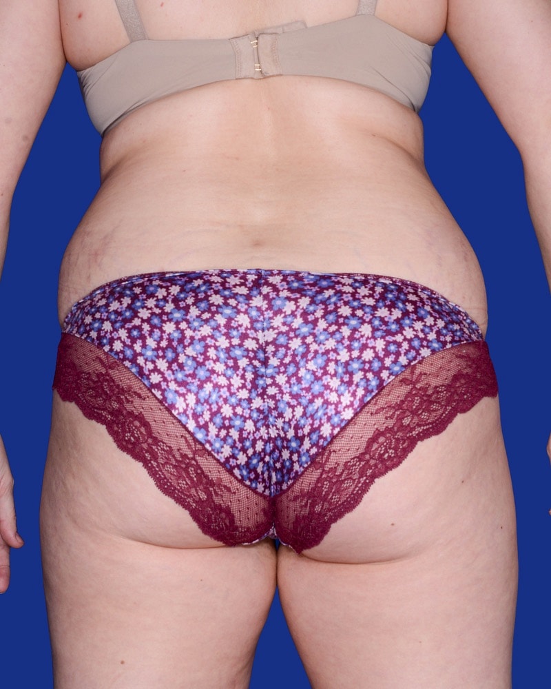 Tummy Tuck Before & After
