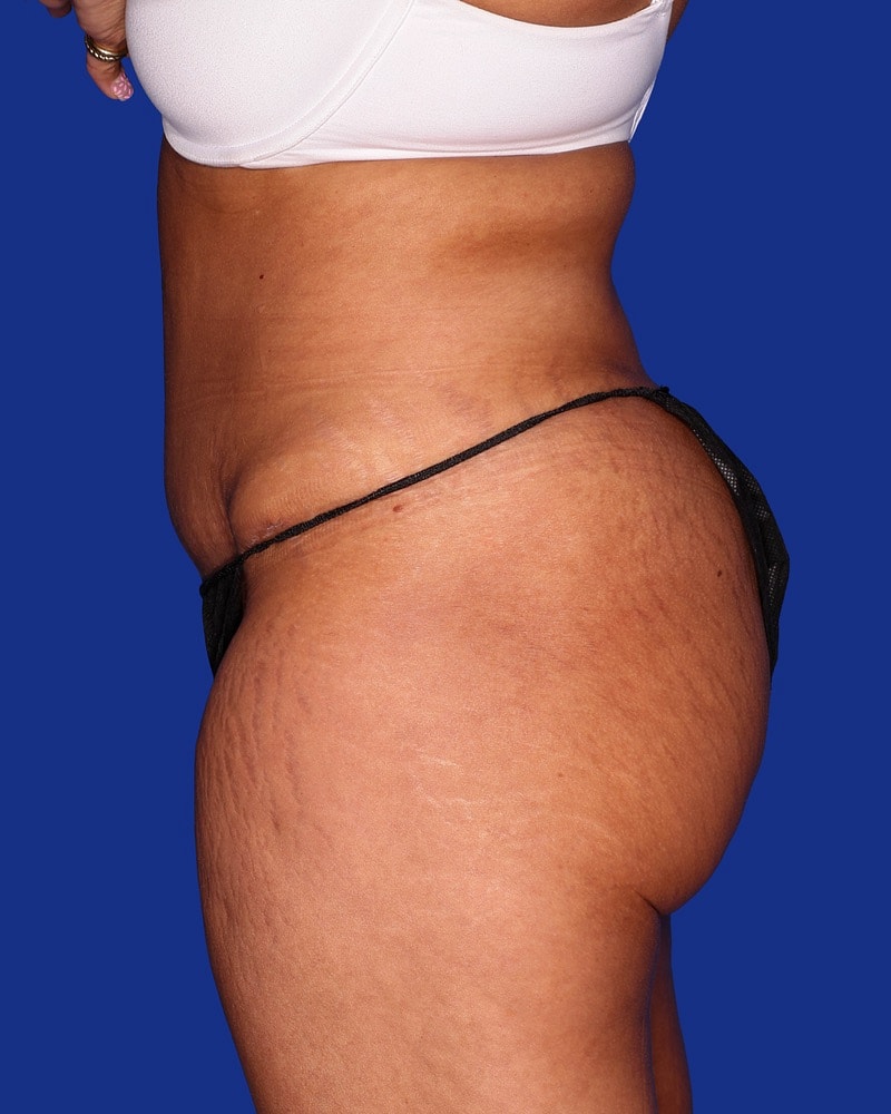 Tummy Tuck Before & After