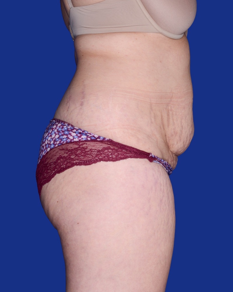 Tummy Tuck Before & After