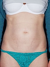 Tummy Tuck Before & After