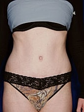 Tummy Tuck Before & After