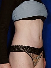 Tummy Tuck Before & After
