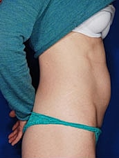Tummy Tuck Before & After