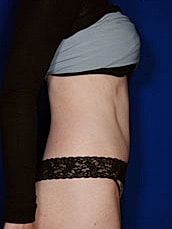 Tummy Tuck Before & After