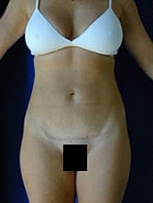 Tummy Tuck Before & After