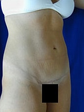 Tummy Tuck Before & After