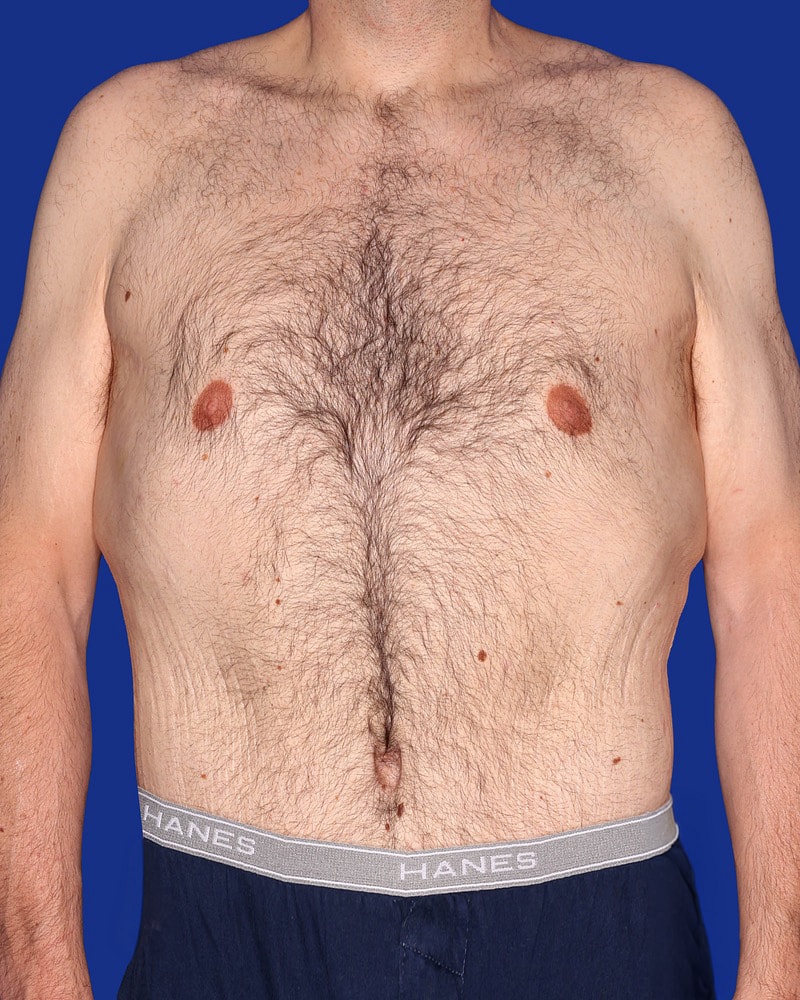Tummy Tuck Before & After