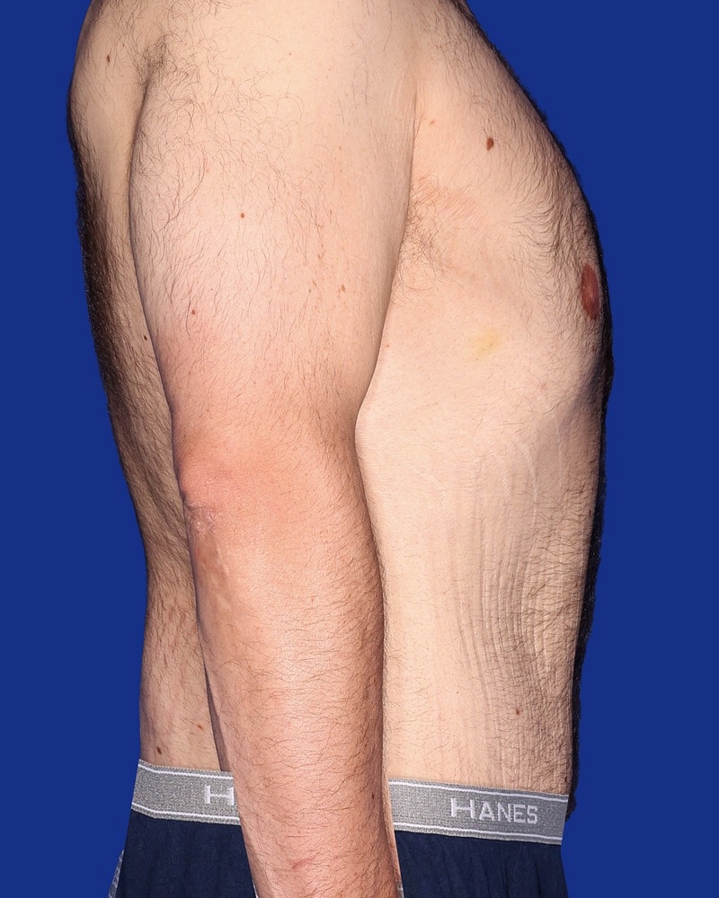 Tummy Tuck Before & After