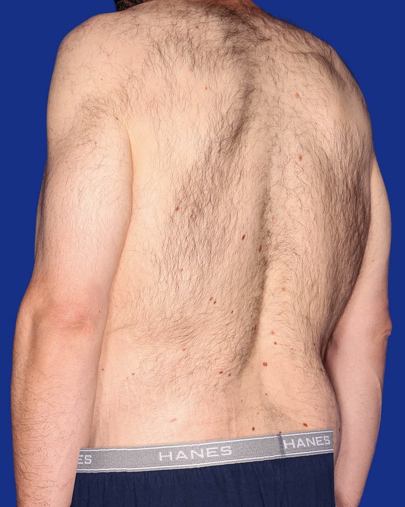 Tummy Tuck Before & After