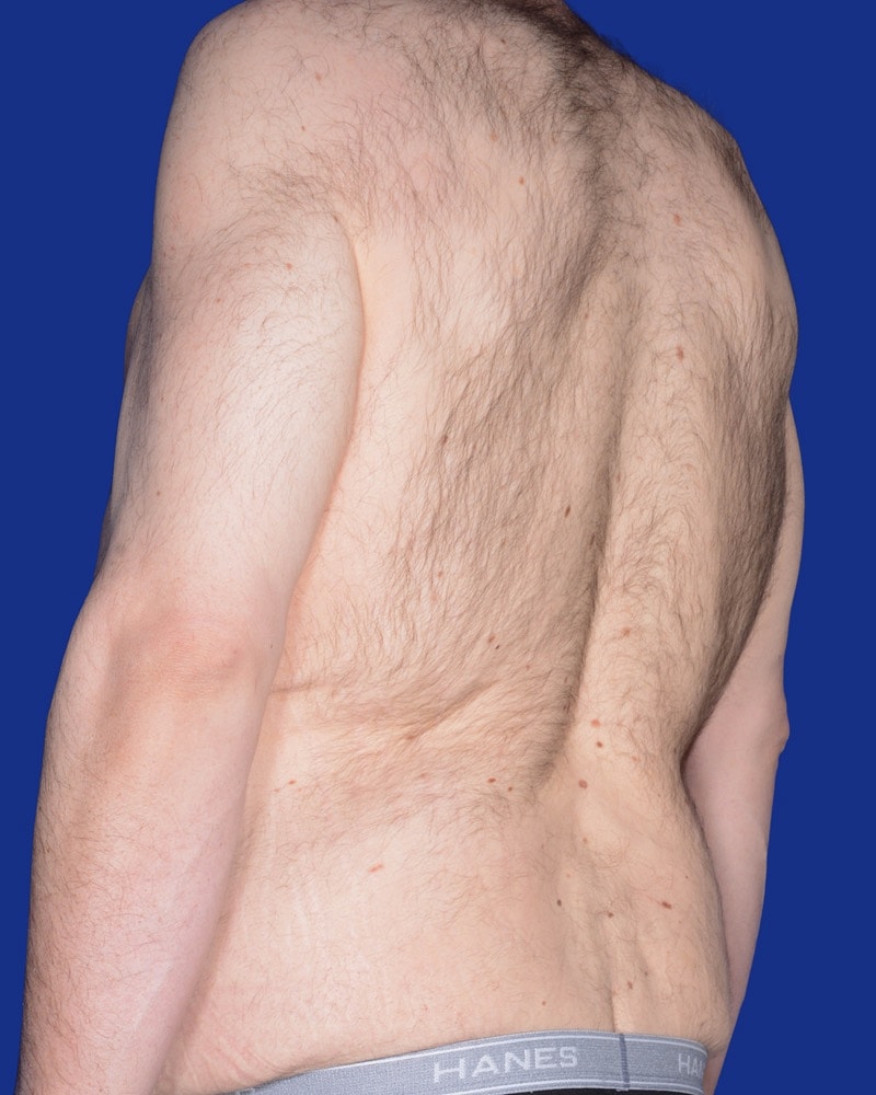 Tummy Tuck Before & After