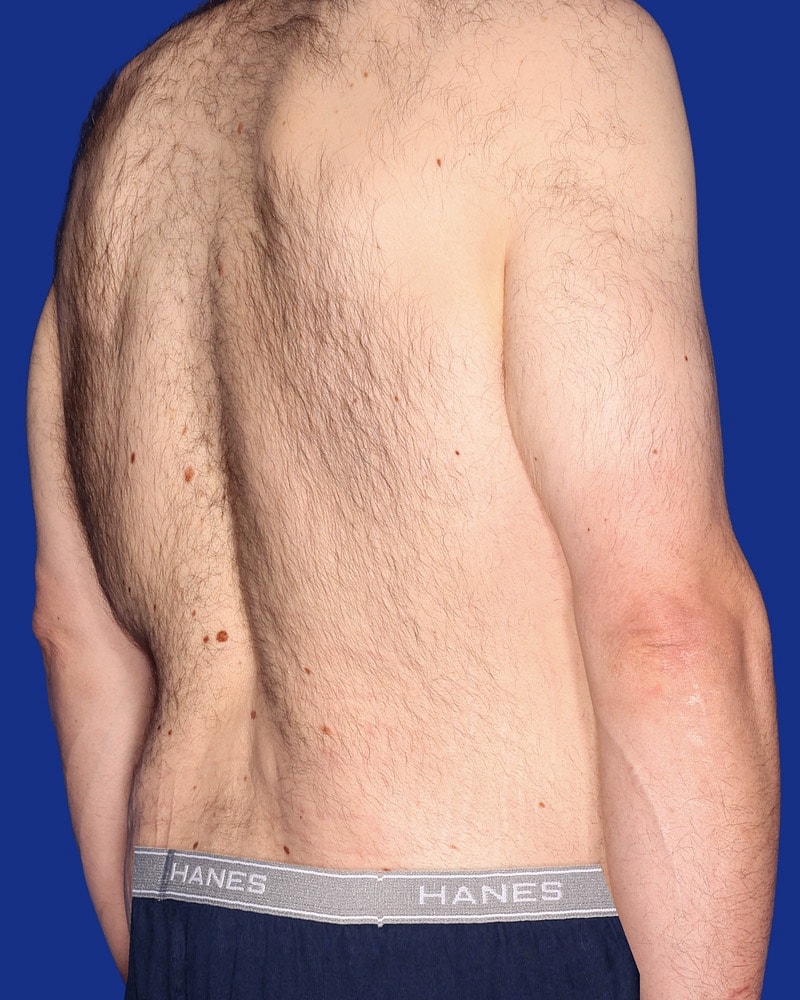 Tummy Tuck Before & After