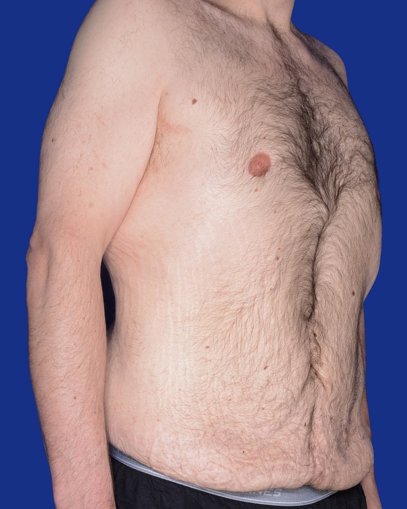 Tummy Tuck Before & After