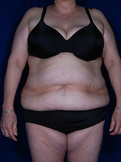 Tummy Tuck Before & After