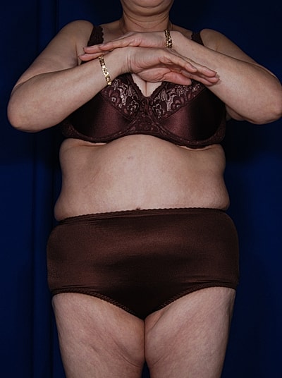 Tummy Tuck Before & After