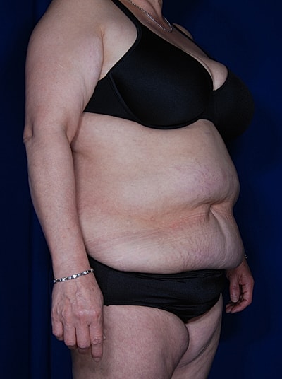 Tummy Tuck Before & After