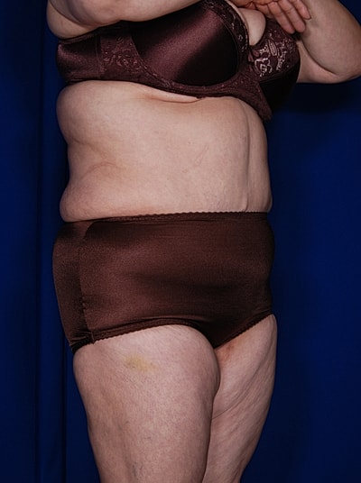 Tummy Tuck Before & After