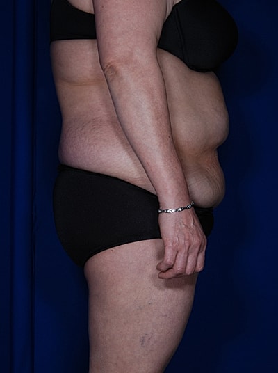 Tummy Tuck Before & After