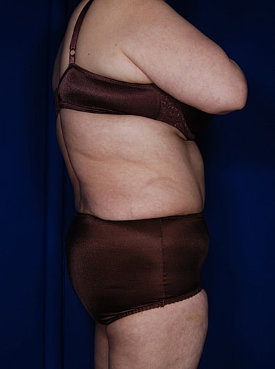 Tummy Tuck Before & After