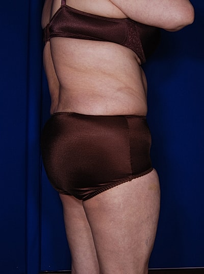 Tummy Tuck Before & After