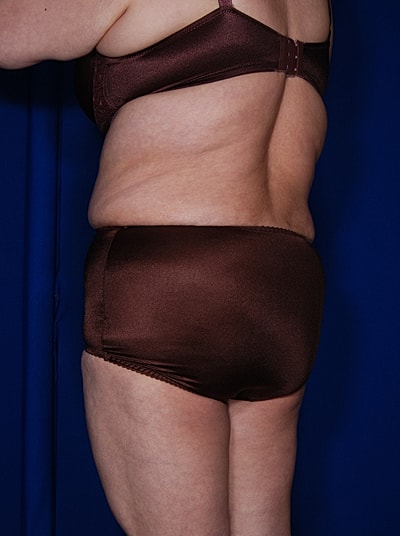 Tummy Tuck Before & After