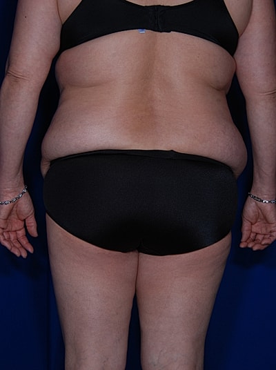 Tummy Tuck Before & After