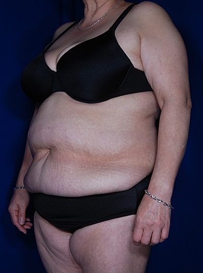 Tummy Tuck Before & After